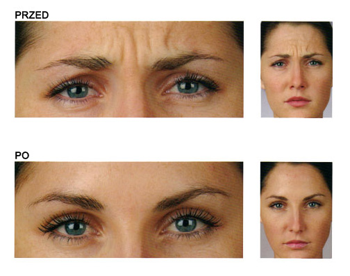 botox_przed_po1111111